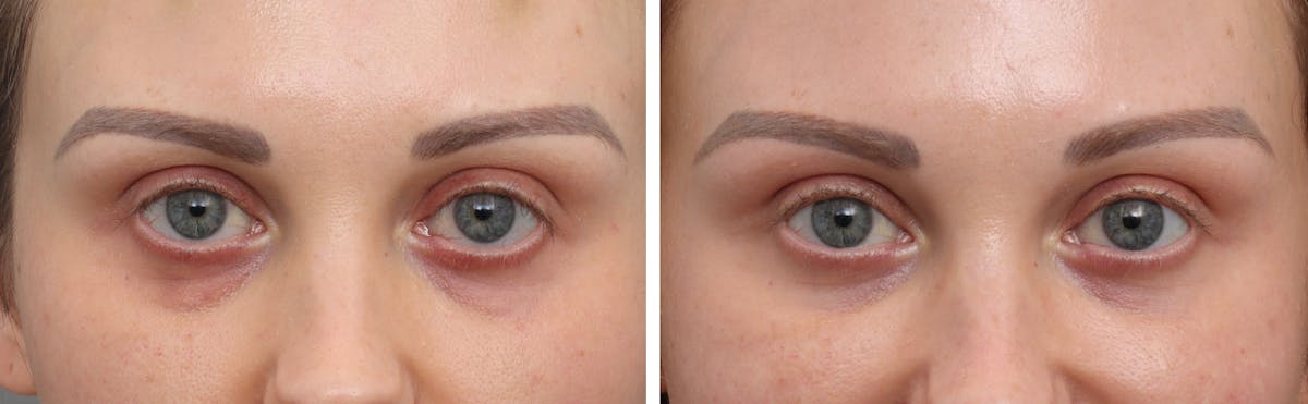 Blepharoplasty Before & After Gallery - Patient 159070 - Image 1