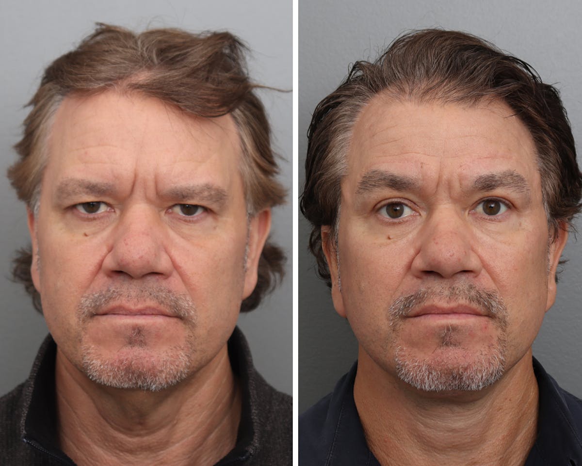 Facelift Before & After Gallery - Patient 138221 - Image 1