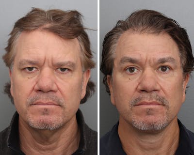 Facelift Before & After Gallery - Patient 138221 - Image 1
