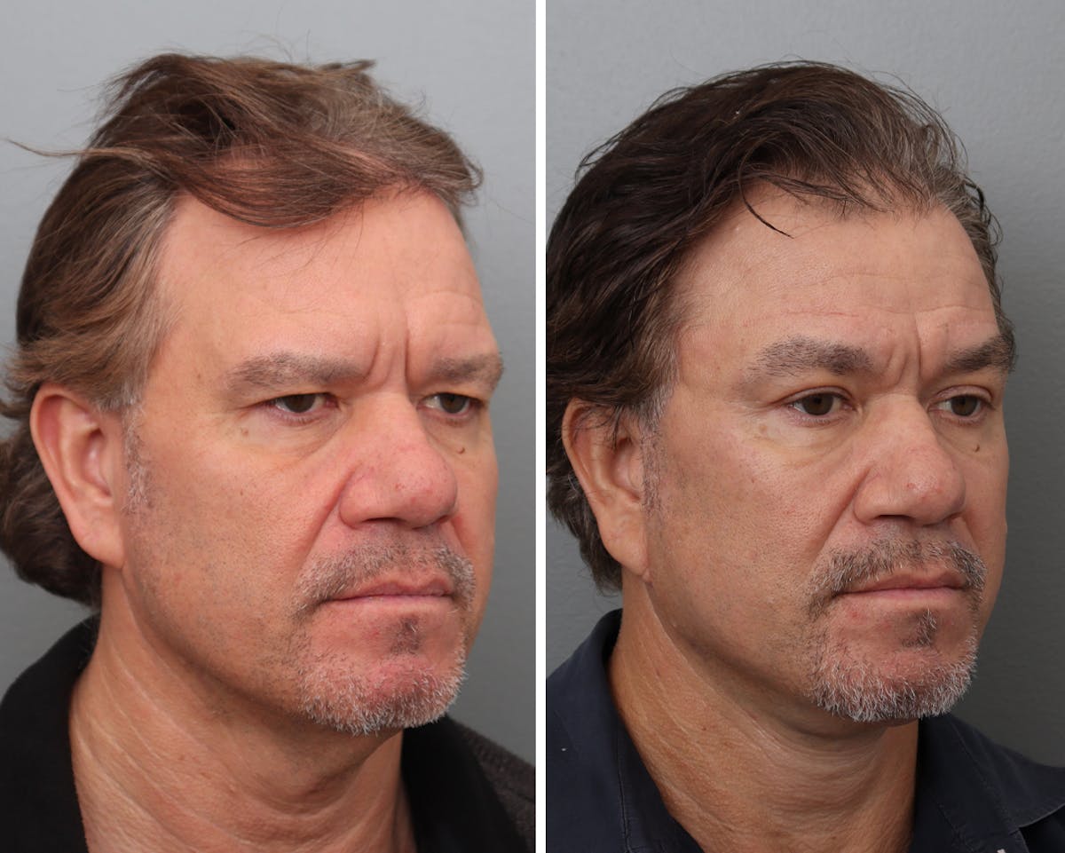 Facelift Before & After Gallery - Patient 138221 - Image 2