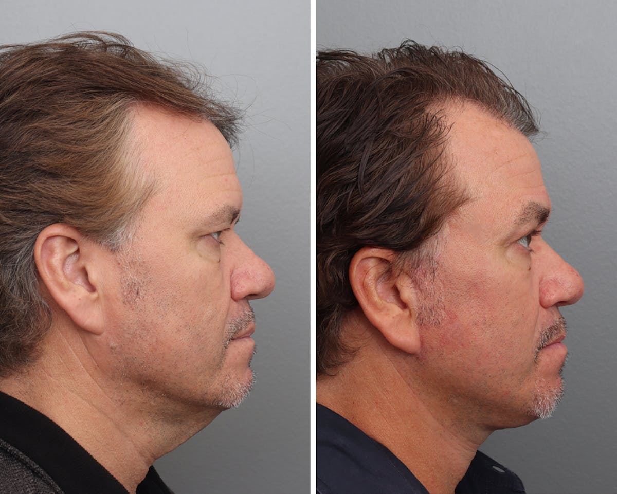 Facelift Before & After Gallery - Patient 138221 - Image 3
