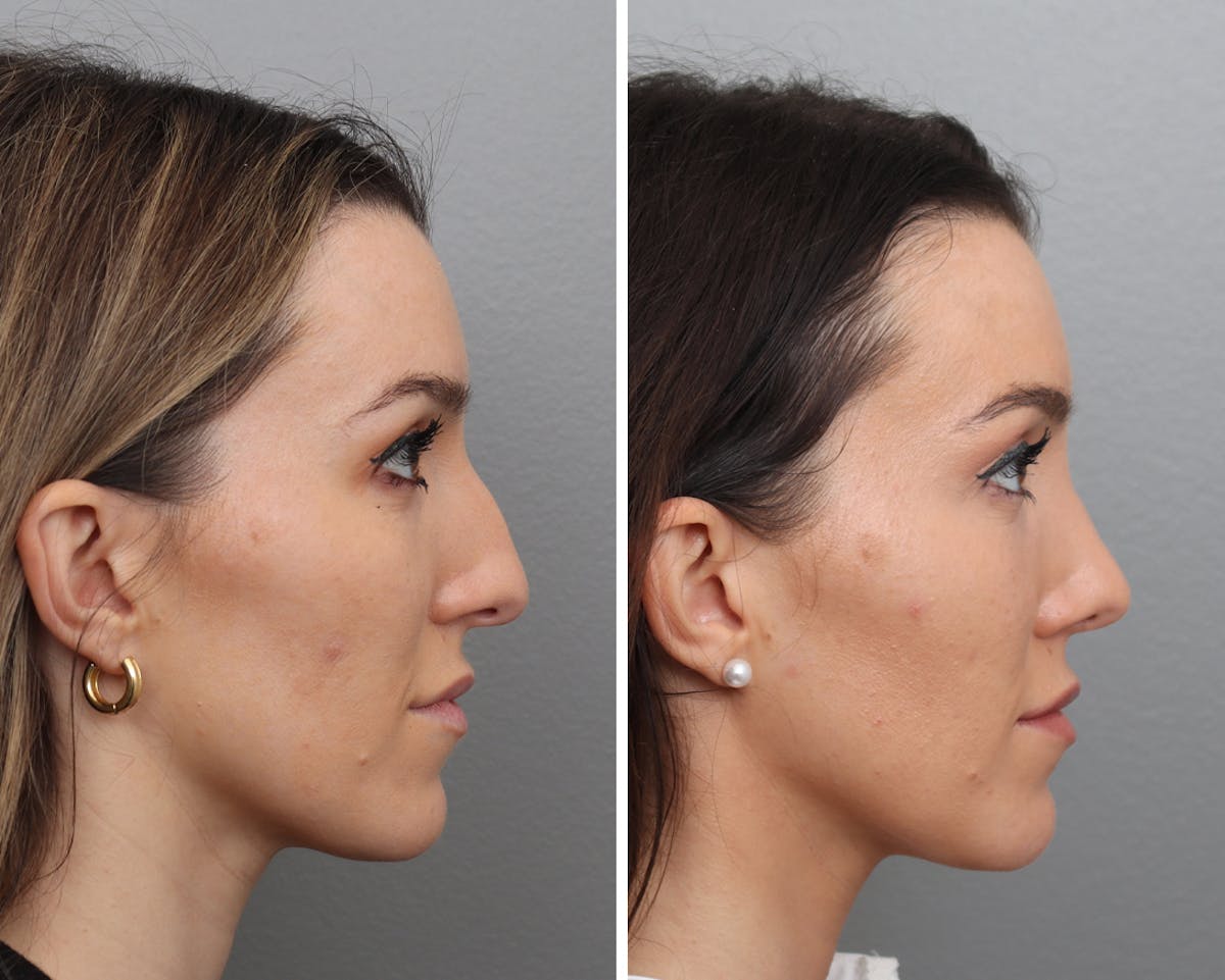 Rhinoplasty Before & After Gallery - Patient 215337 - Image 1