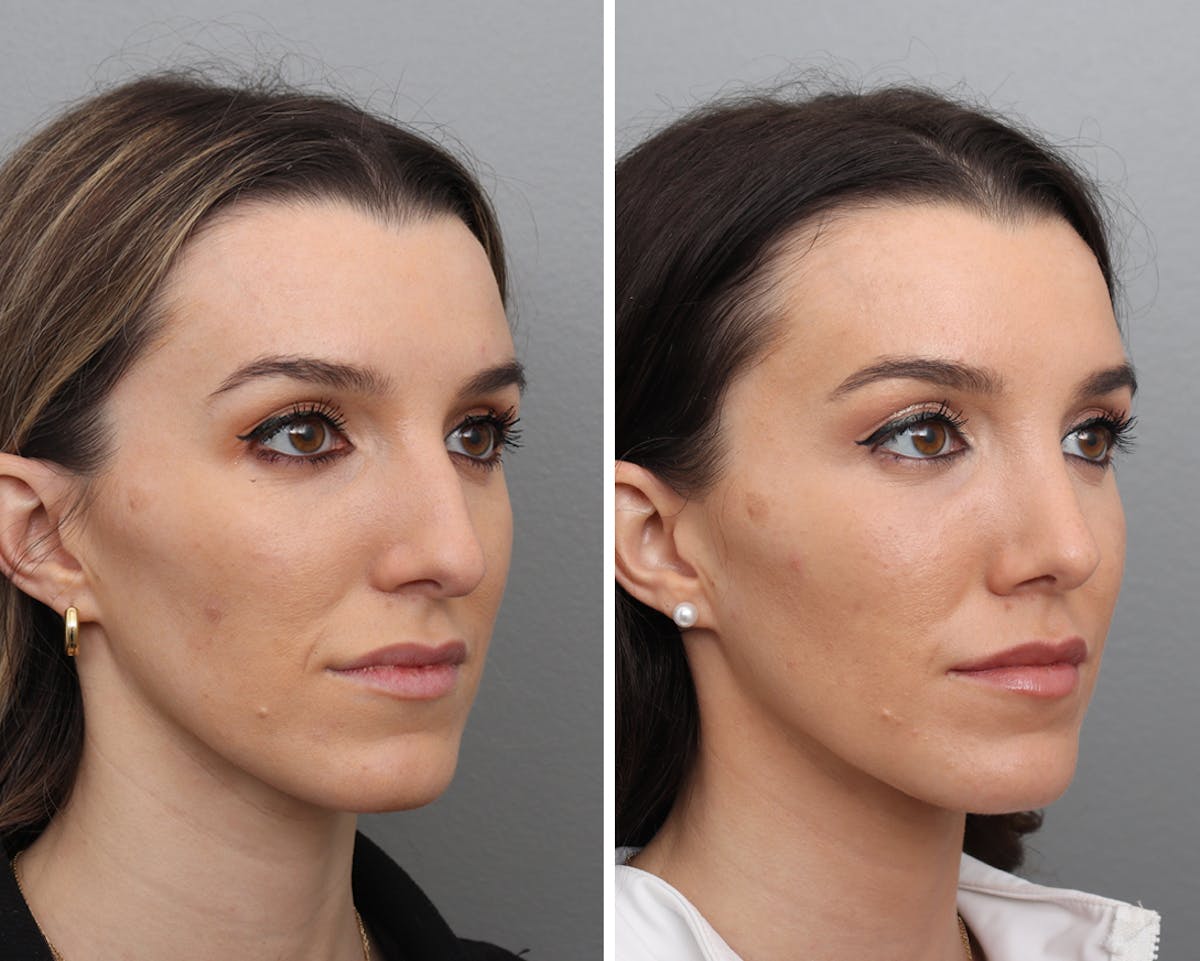 Rhinoplasty Before & After Gallery - Patient 215337 - Image 2