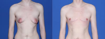 Female to Male Top Surgery Before & After Gallery - Patient 111054 - Image 1
