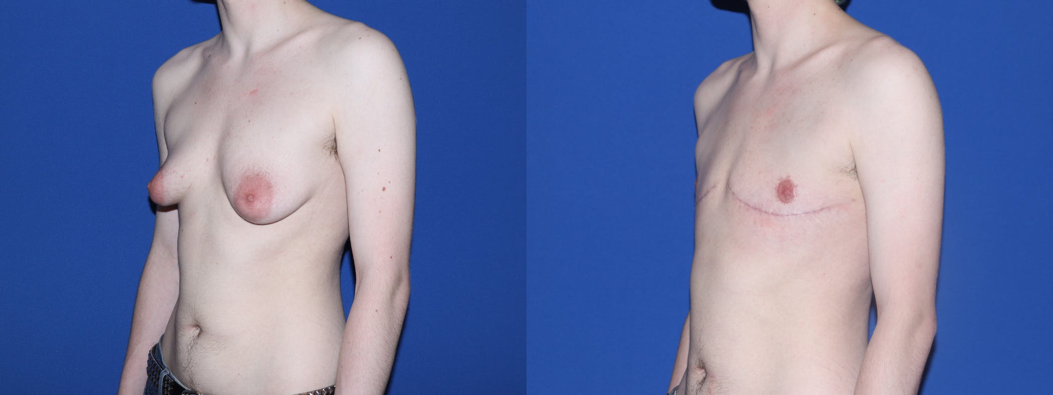 Female to Male Top Surgery Before & After Gallery - Patient 111054 - Image 2