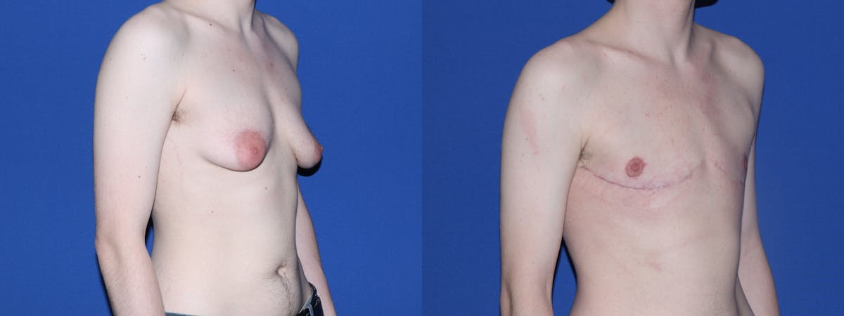 Female to Male Top Surgery Before & After Gallery - Patient 111054 - Image 3