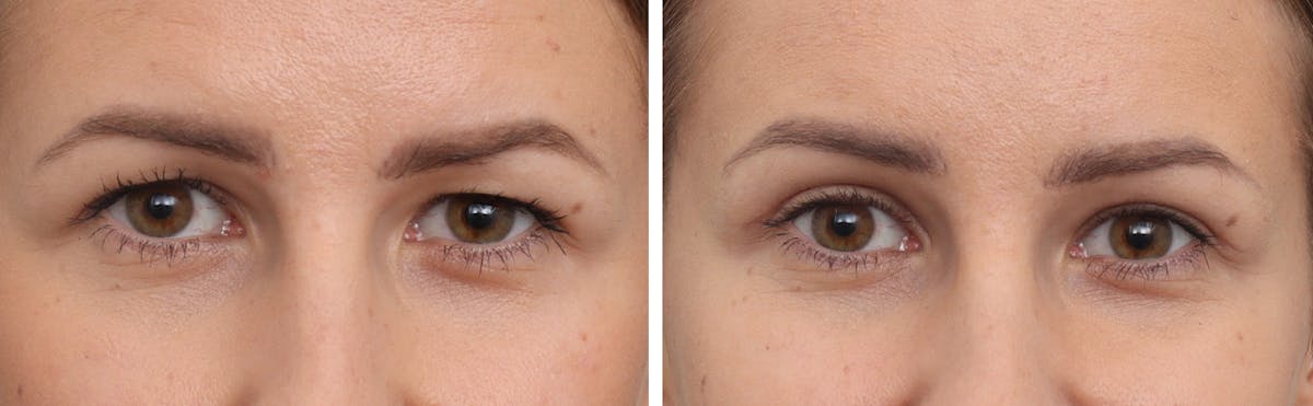Brow Lift Before & After Gallery - Patient 403586 - Image 1