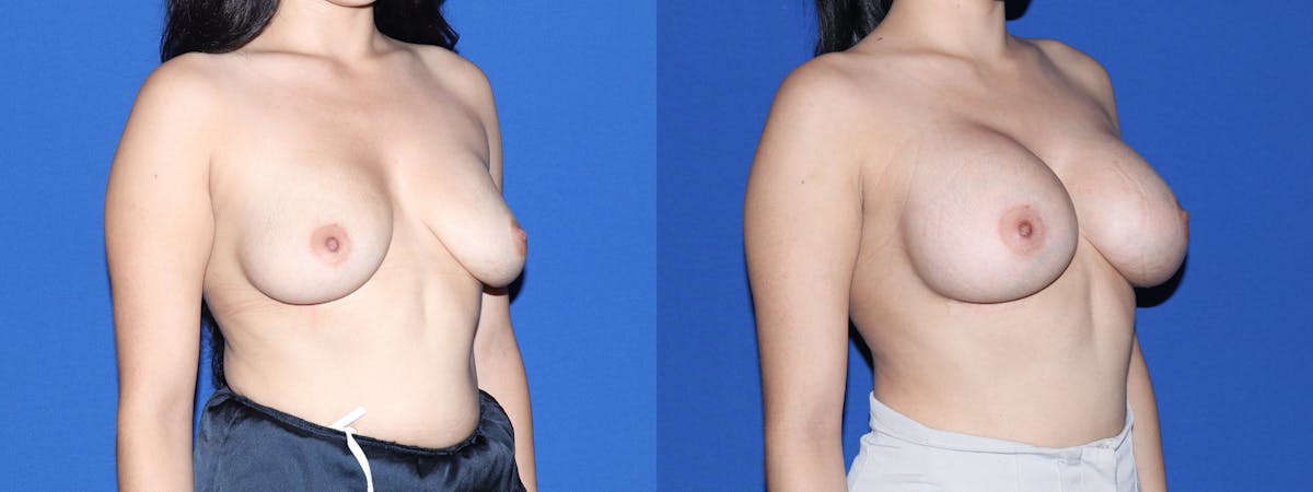 Breast Augmentation Before & After Gallery - Patient 749457 - Image 3