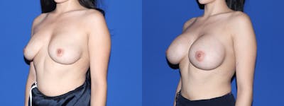Breast Augmentation Before & After Gallery - Patient 749457 - Image 1