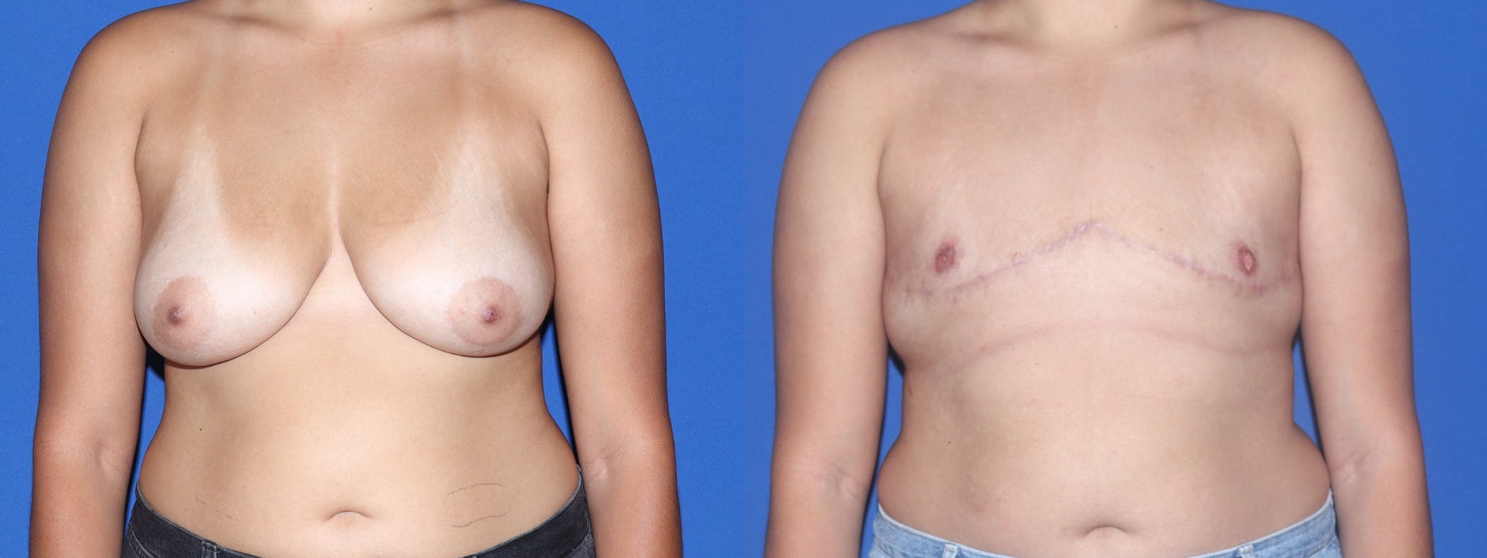 Female to Male Top Surgery Before & After Gallery - Patient 343472 - Image 1