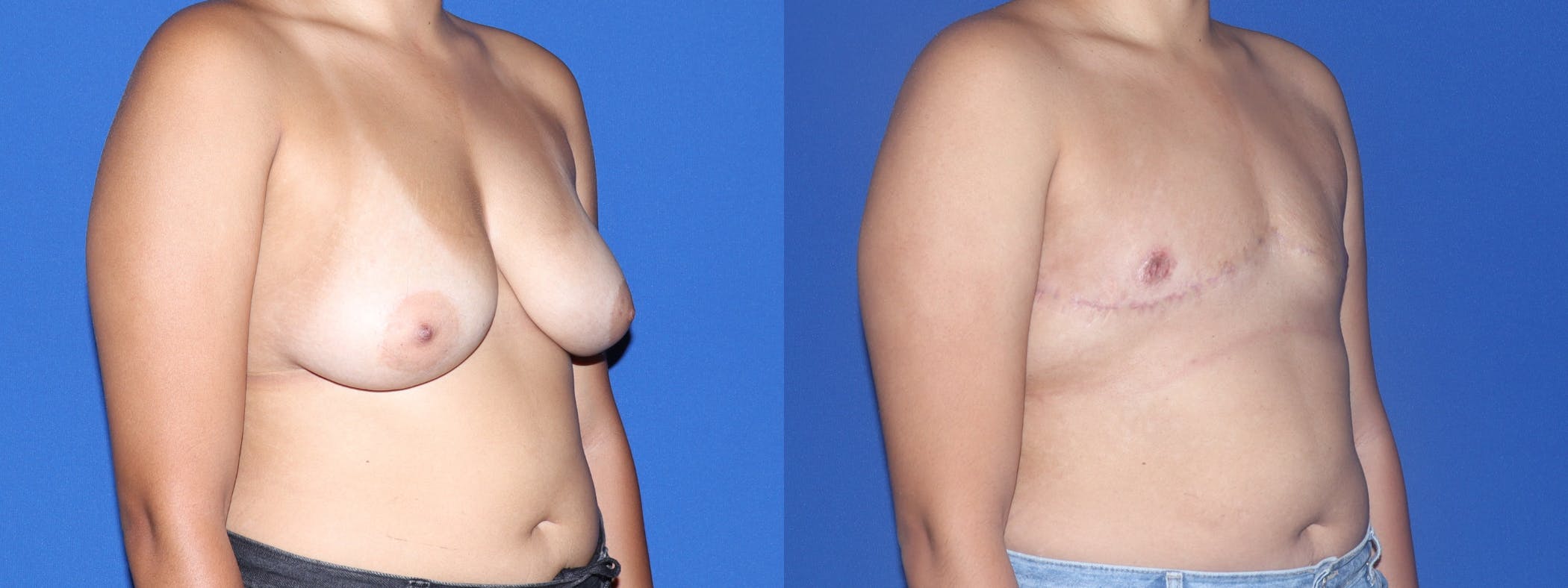 Female to Male Top Surgery Before & After Gallery - Patient 343472 - Image 2
