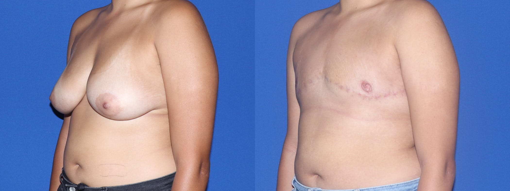 Female to Male Top Surgery Before & After Gallery - Patient 343472 - Image 3