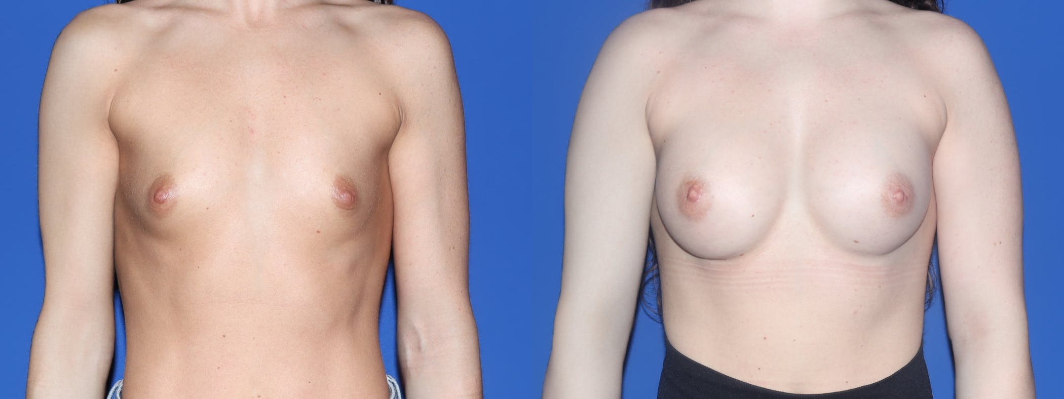 Breast Augmentation Before & After Gallery - Patient 268293 - Image 1