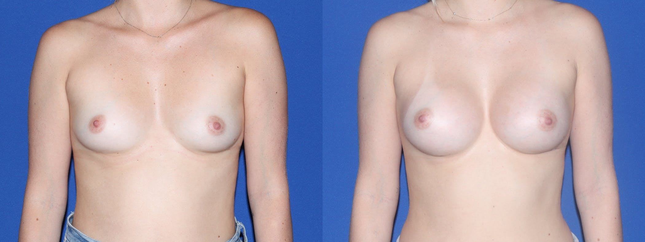 Breast Augmentation Before & After Gallery - Patient 130895 - Image 2