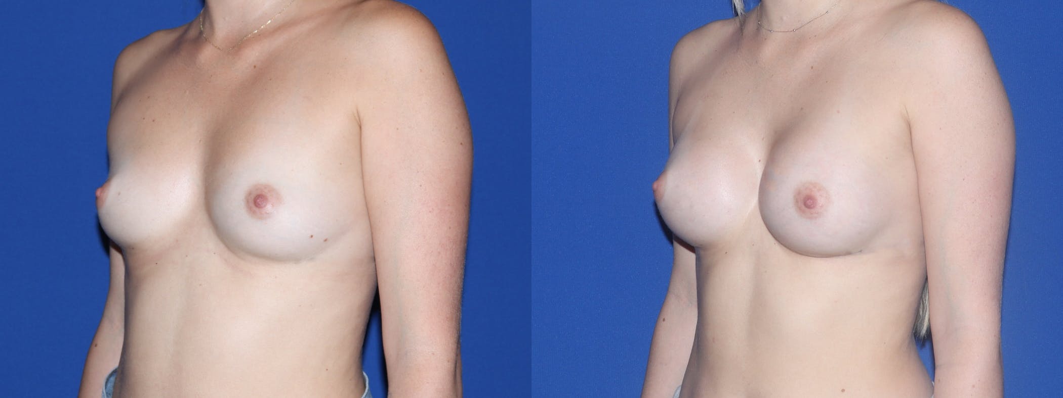 Breast Augmentation Before & After Gallery - Patient 130895 - Image 1