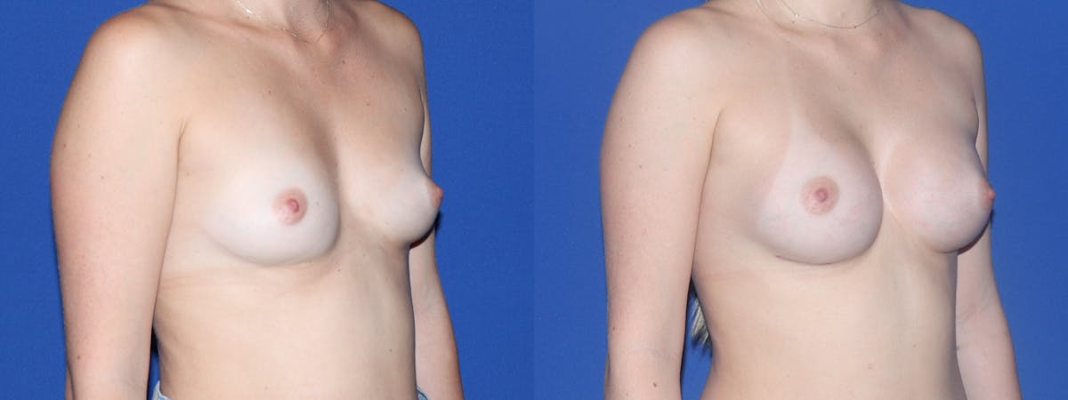 Breast Augmentation Before & After Gallery - Patient 130895 - Image 3