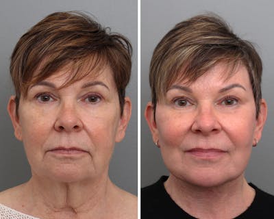 Facelift Before & After Gallery - Patient 138937 - Image 1