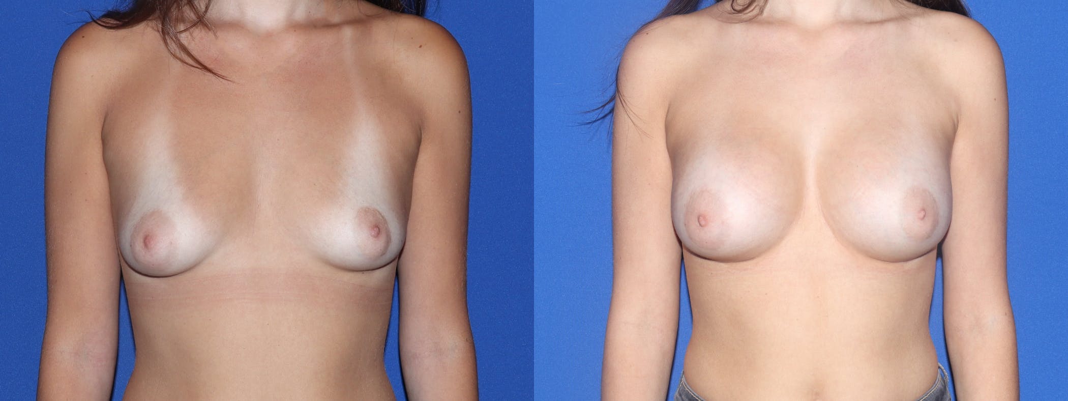 Breast Augmentation Before & After Gallery - Patient 111949 - Image 2