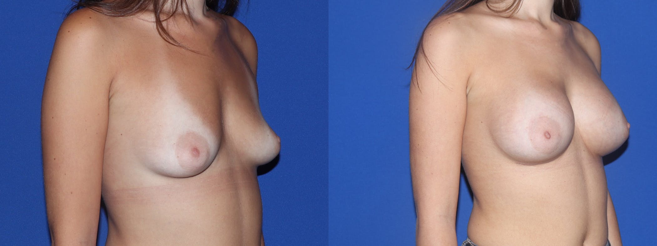 Breast Augmentation Before & After Gallery - Patient 111949 - Image 3