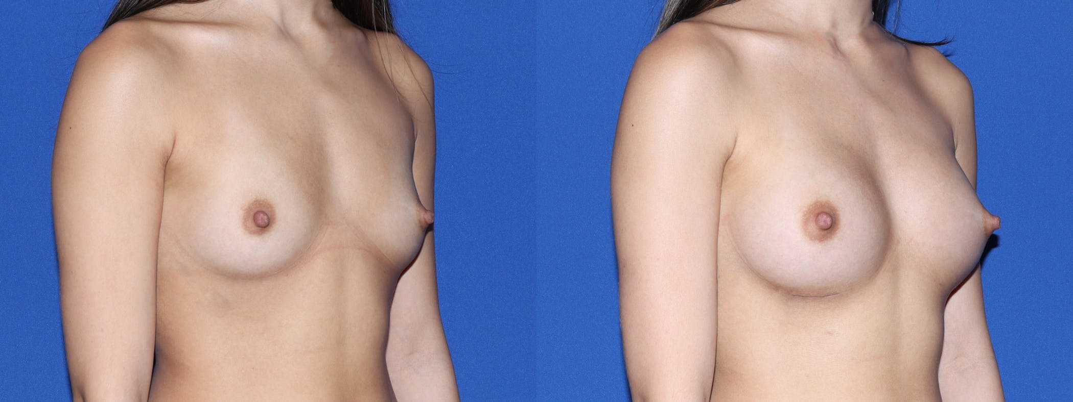 Breast Augmentation Before & After Gallery - Patient 417935 - Image 3