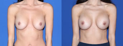 Breast Implant Exchange Before & After Gallery - Patient 385875 - Image 1