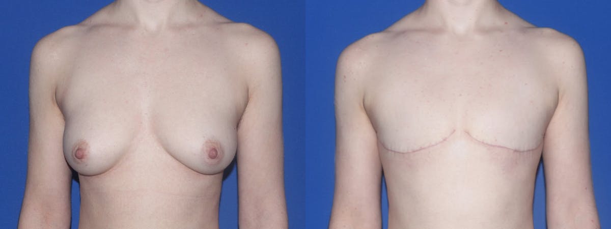 Female to Male Top Surgery Before & After Gallery - Patient 790565 - Image 1