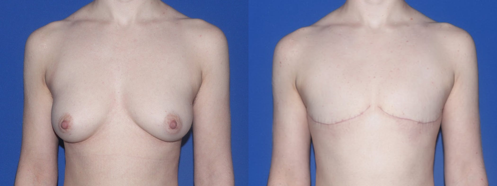 Female to Male Top Surgery Before & After Gallery - Patient 790565 - Image 1