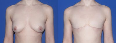 Female to Male Top Surgery Before & After Gallery - Patient 790565 - Image 1