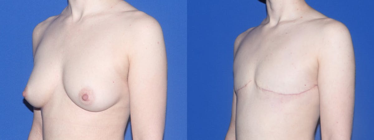 Female to Male Top Surgery Before & After Gallery - Patient 790565 - Image 3