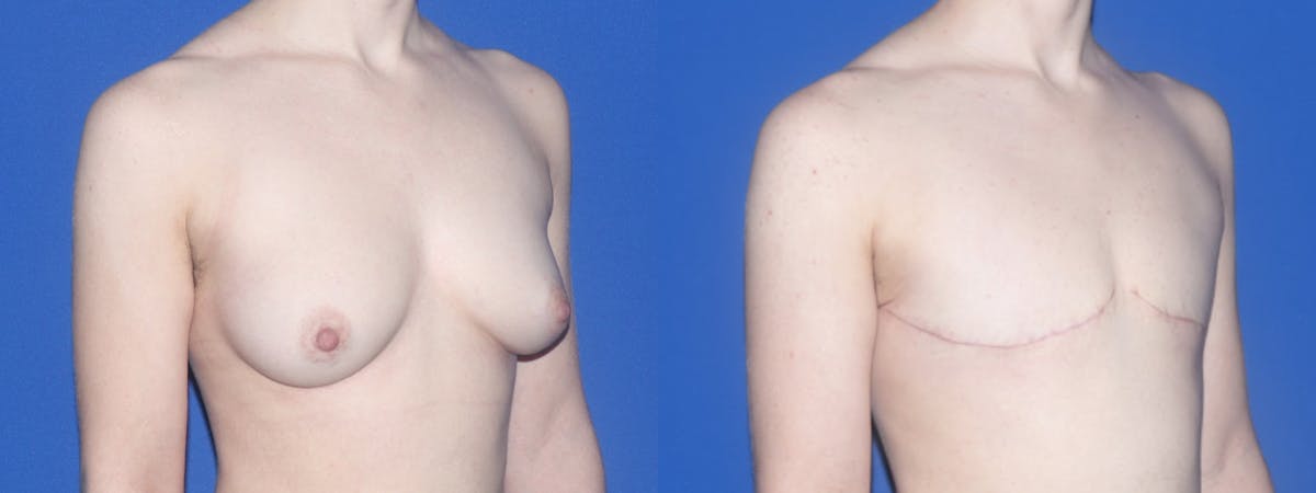 Female to Male Top Surgery Before & After Gallery - Patient 790565 - Image 2