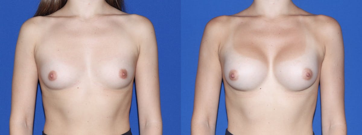 Breast Augmentation Before & After Gallery - Patient 161171 - Image 2