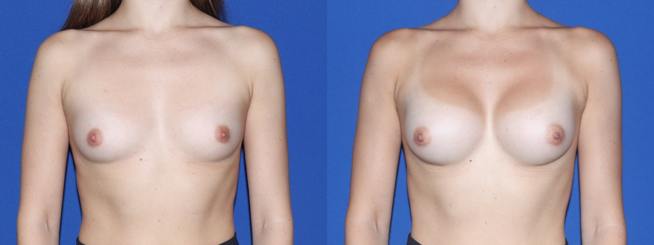 Breast Augmentation Before & After Gallery - Patient 161171 - Image 2