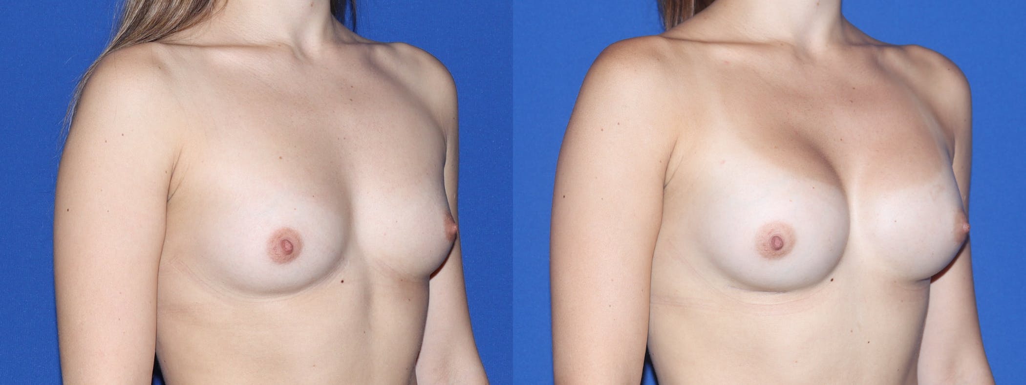 Breast Augmentation Before & After Gallery - Patient 161171 - Image 3