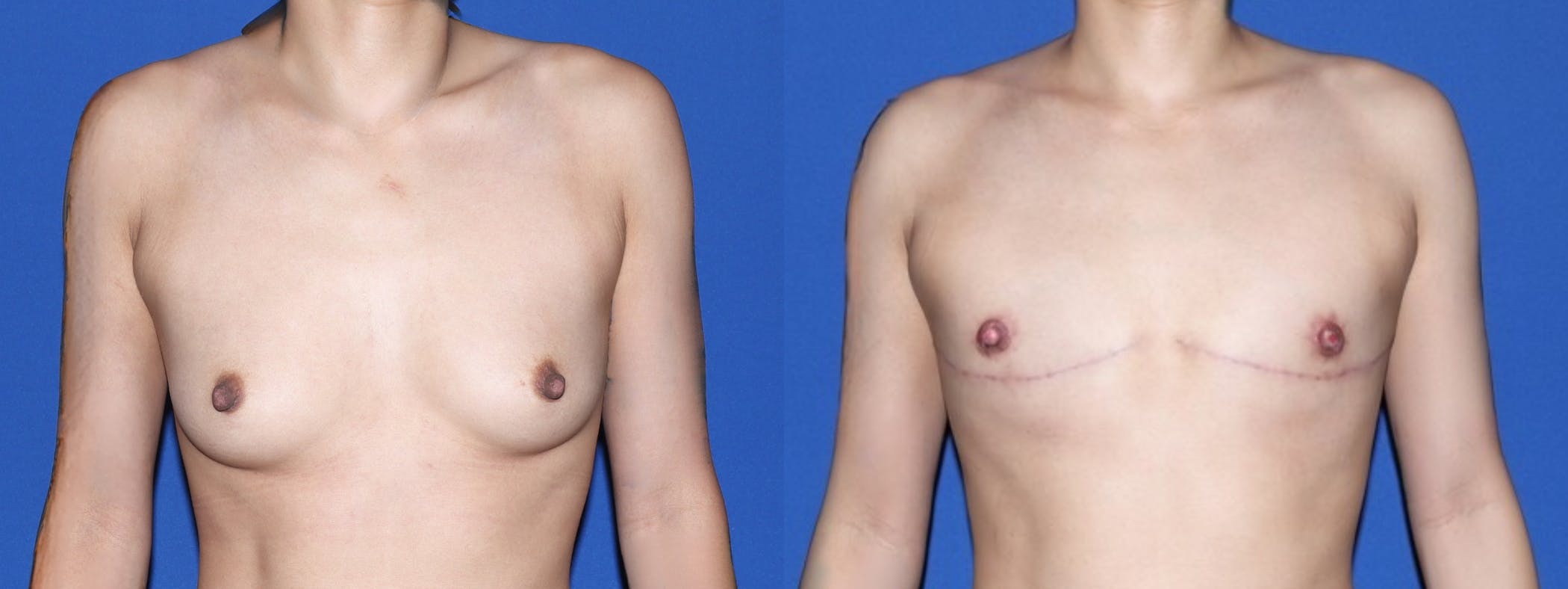 Female to Male Top Surgery Before & After Gallery - Patient 101704 - Image 1