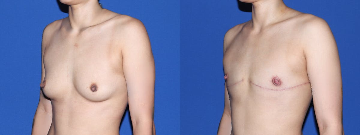 Female to Male Top Surgery Before & After Gallery - Patient 101704 - Image 3