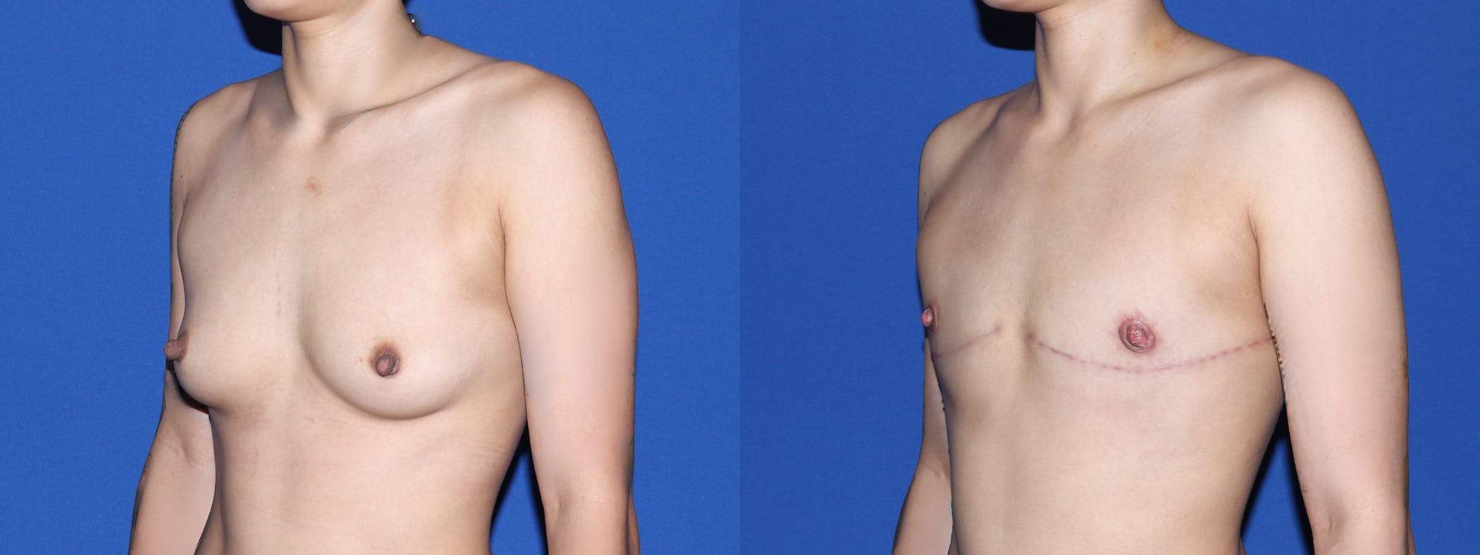Female to Male Top Surgery Before & After Gallery - Patient 101704 - Image 3