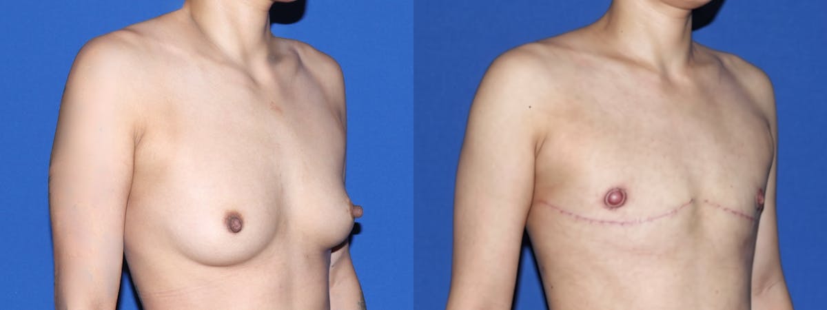 Female to Male Top Surgery Before & After Gallery - Patient 101704 - Image 2
