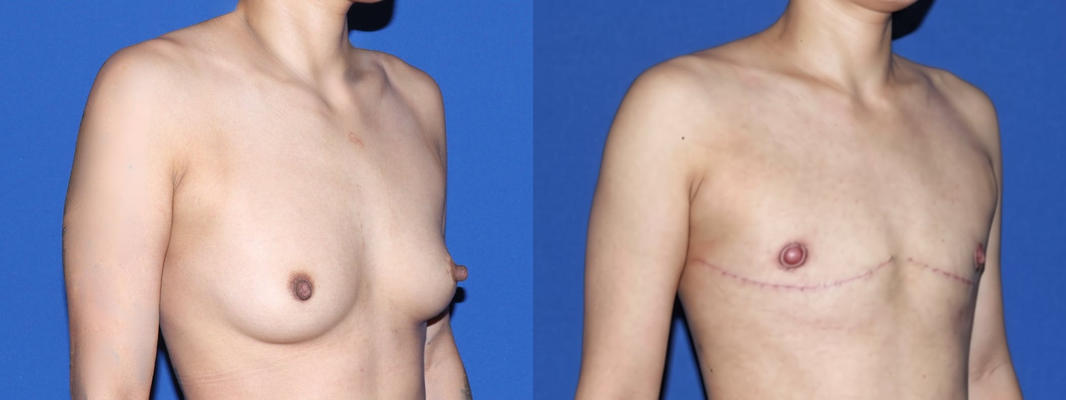 Female to Male Top Surgery Before & After Gallery - Patient 101704 - Image 2