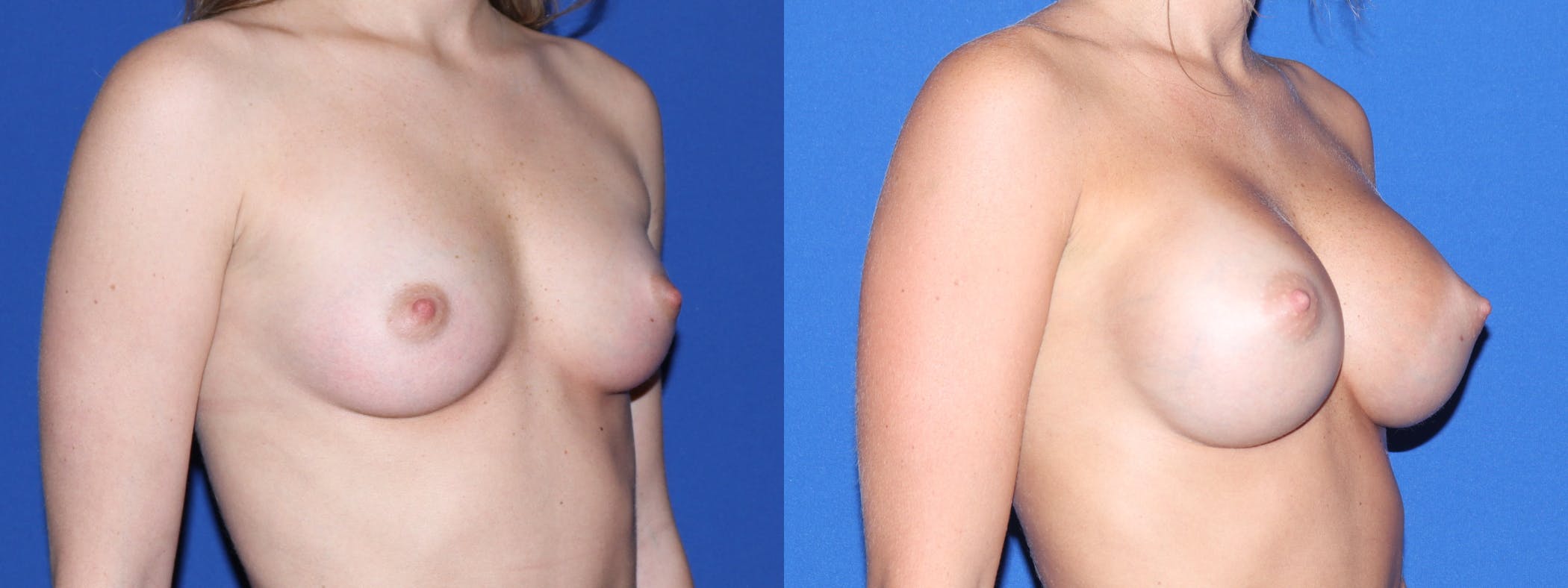 Breast Augmentation Before & After Gallery - Patient 404209 - Image 3