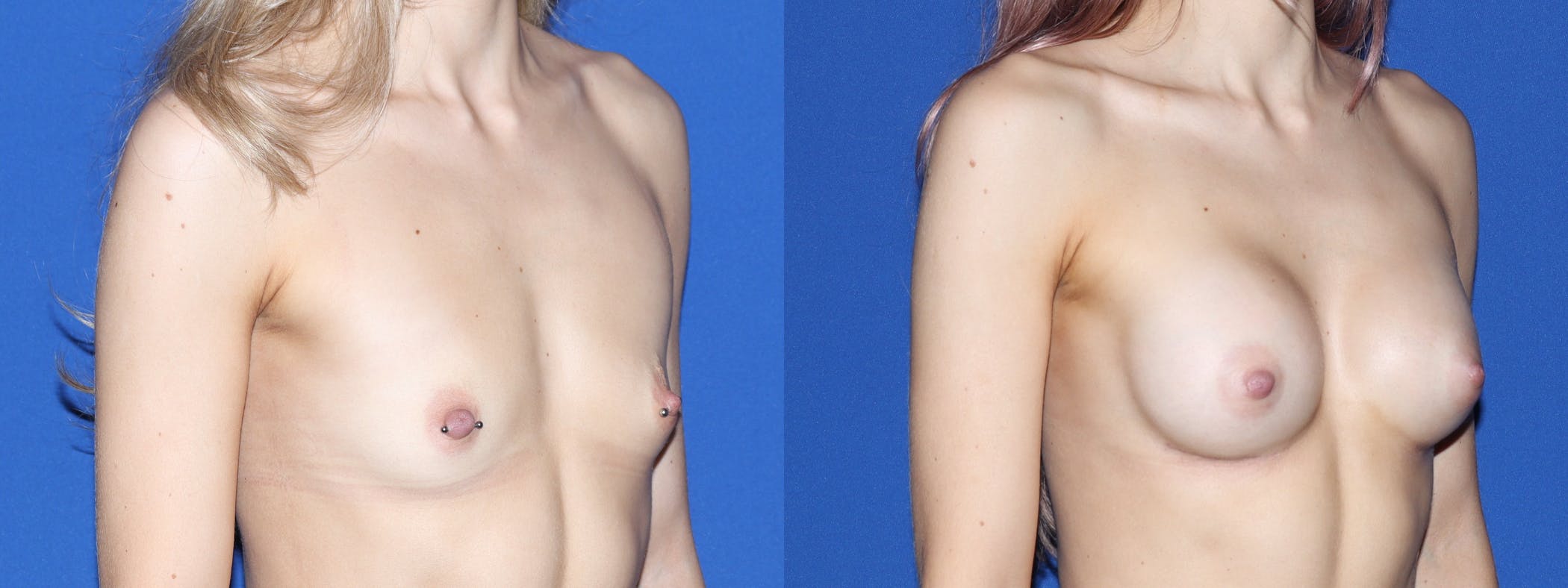Breast Augmentation Before & After Gallery - Patient 120692 - Image 3
