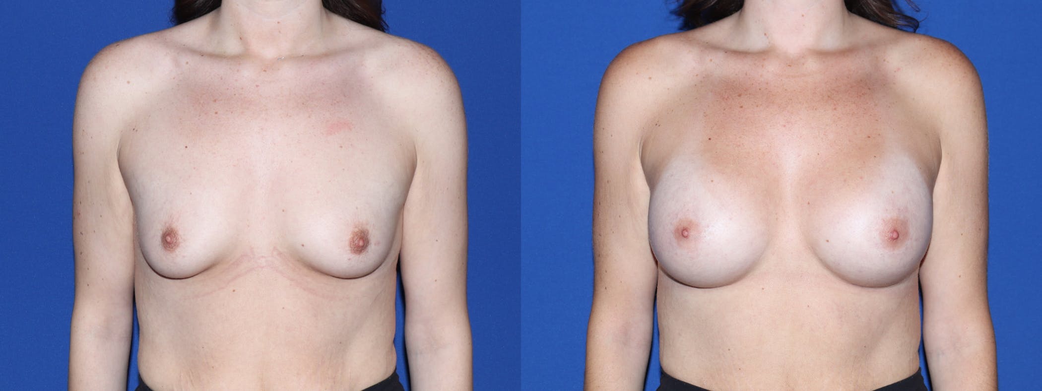 Breast Augmentation Before & After Gallery - Patient 419545 - Image 2