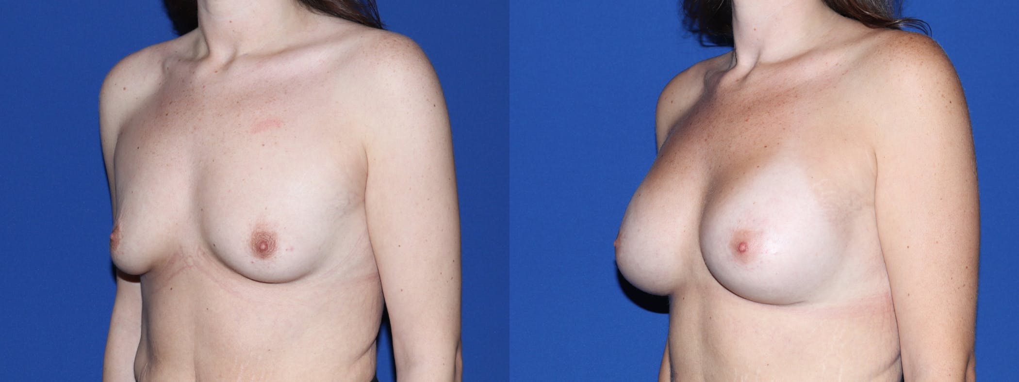 Breast Augmentation Before & After Gallery - Patient 419545 - Image 1