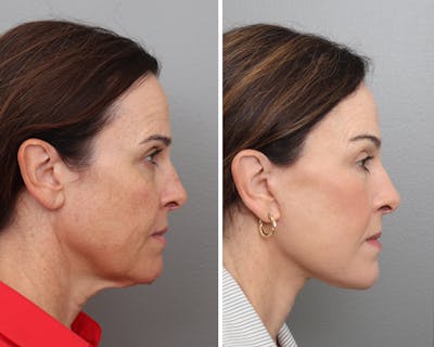 Facelift Before & After Gallery - Patient 113237 - Image 1