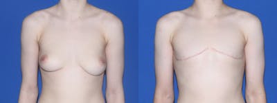 Female to Male Top Surgery Before & After Gallery - Patient 252409 - Image 1