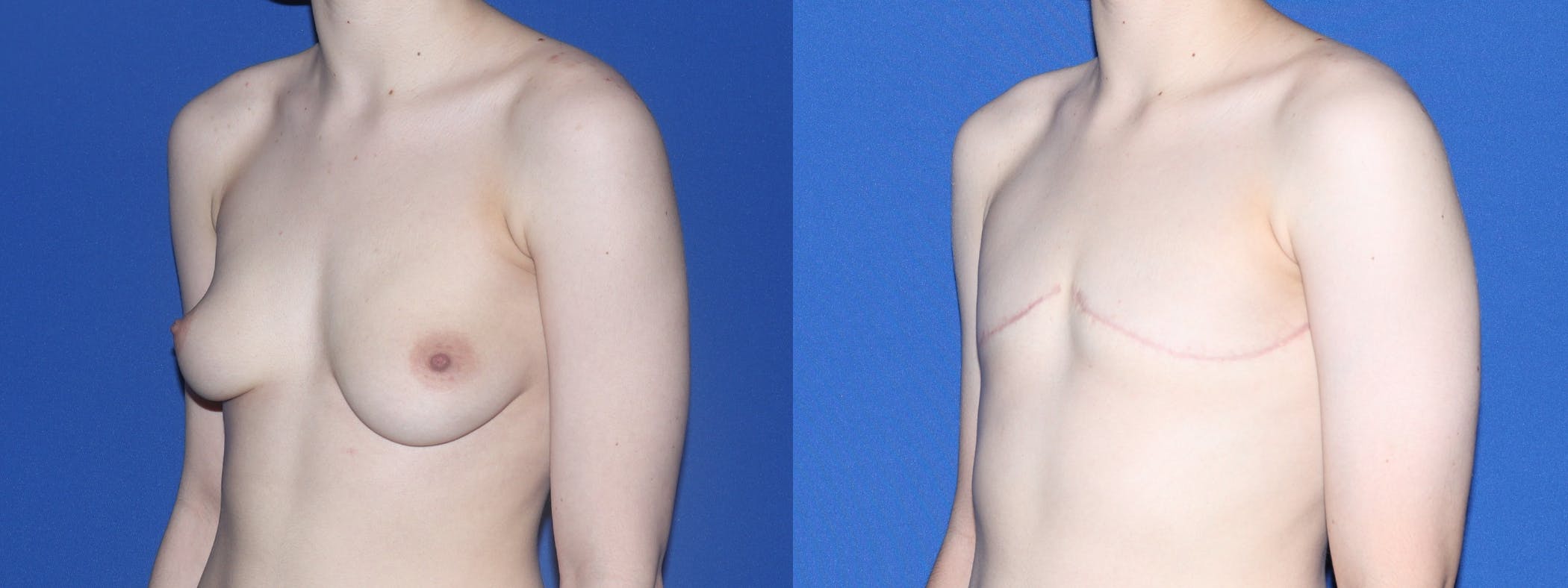 Female to Male Top Surgery Before & After Gallery - Patient 252409 - Image 3