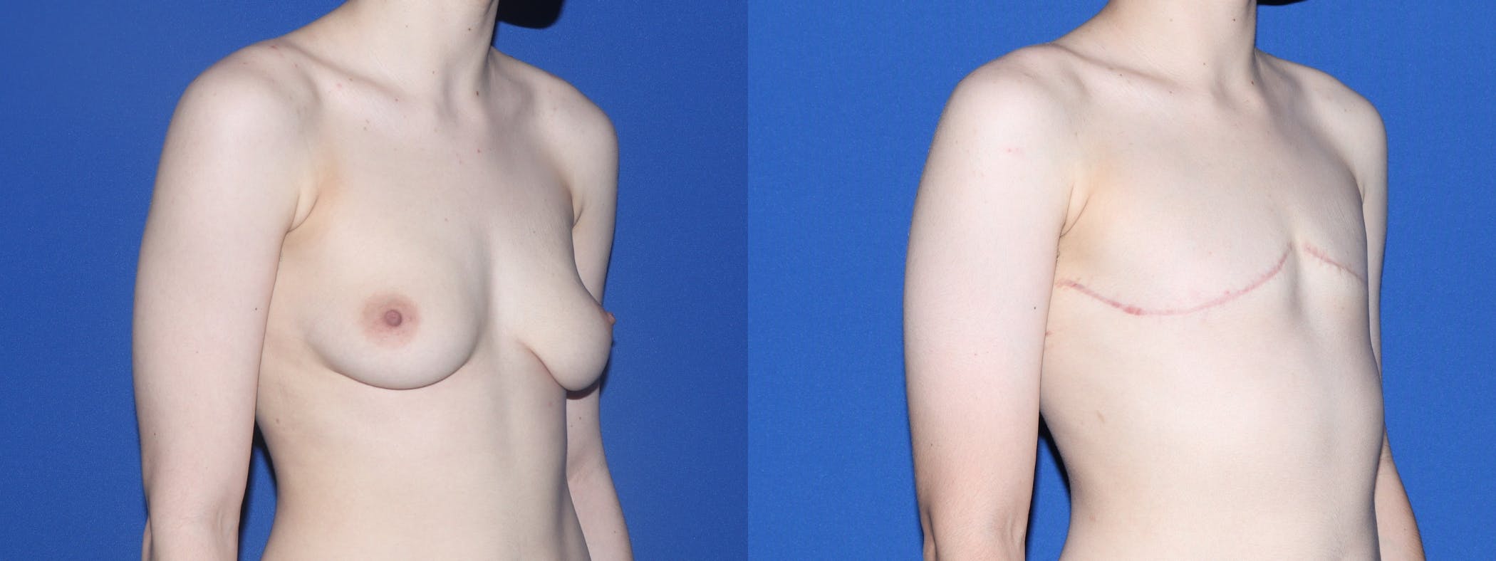 Female to Male Top Surgery Before & After Gallery - Patient 252409 - Image 2