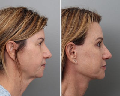 Facelift Before & After Gallery - Patient 184066 - Image 1