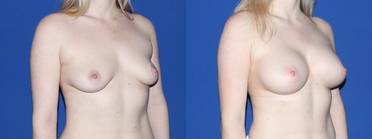 Breast Augmentation Before & After Gallery - Patient 322230 - Image 3