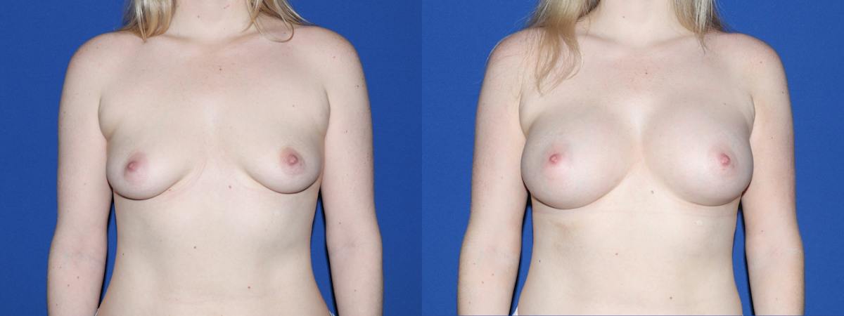 Breast Augmentation Before & After Gallery - Patient 322230 - Image 2