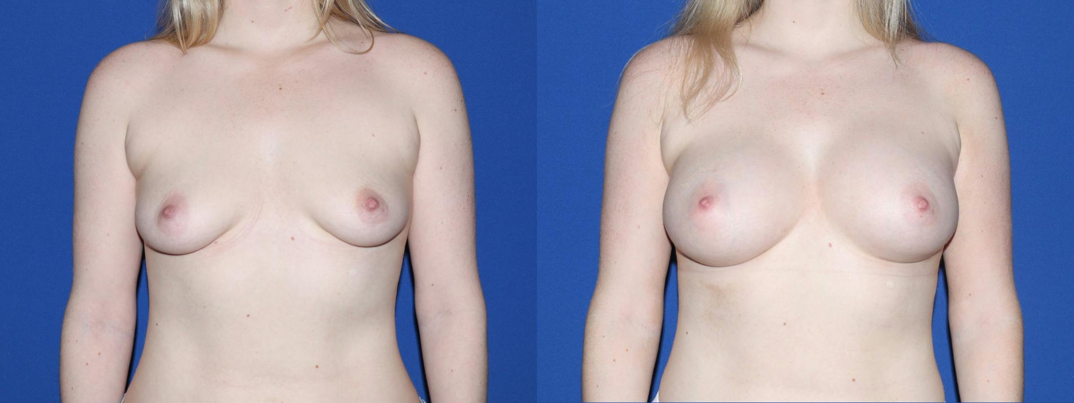 Breast Augmentation Before & After Gallery - Patient 322230 - Image 2